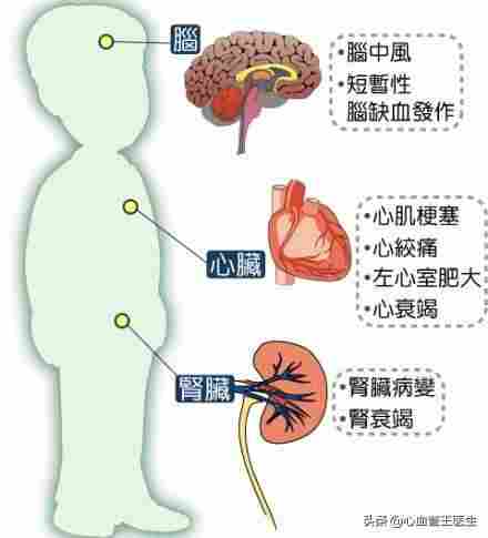 普利类降压药，包括哪些药物？这种药物适合哪些人？